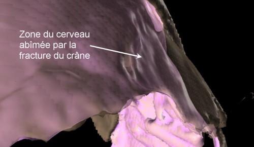 Vu par l'arrière, le cerveau reconstitué de l'adolescent, superposé à son crâne. Il a été touché un peu au-dessus du front, à droite.